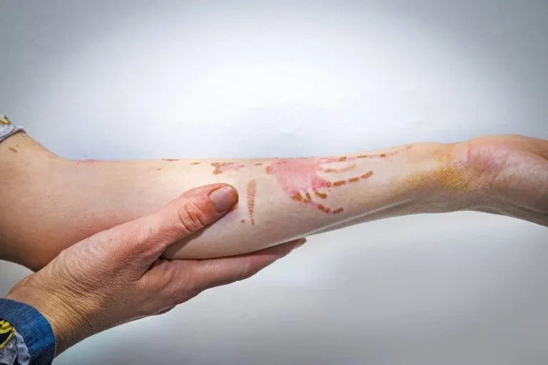 BLOG 20 Top Reasons To Hire A Burn Injury Attorney In Houston