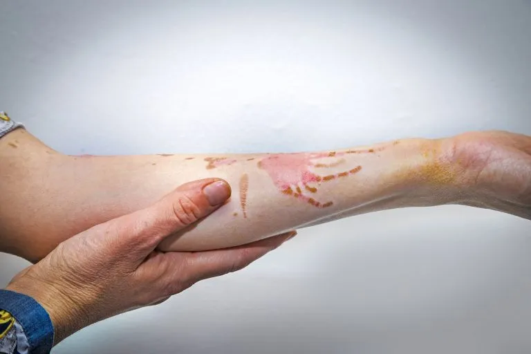 Burned Arm - Contact a Houston Burn Injury Lawyer