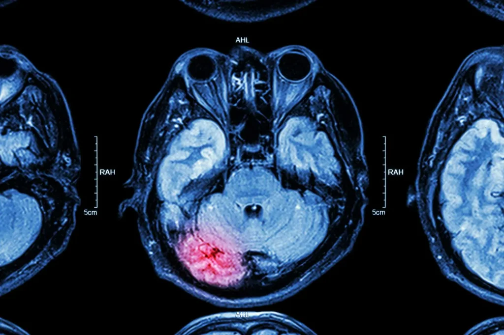 Traumatic Brain Injury Legal Issues