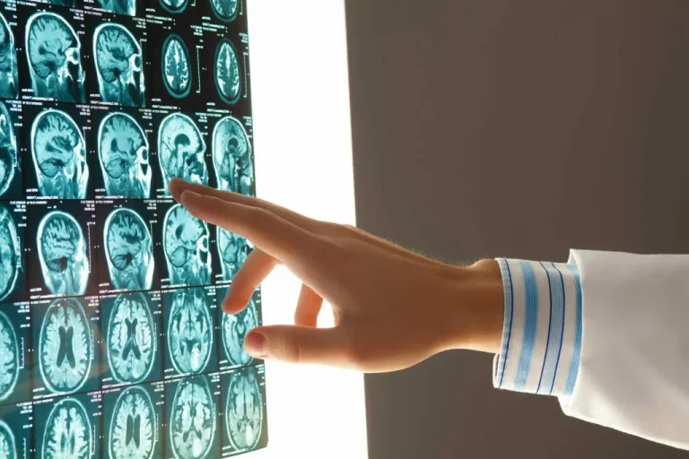 How To Choose A Houston Brain Injury Attorney